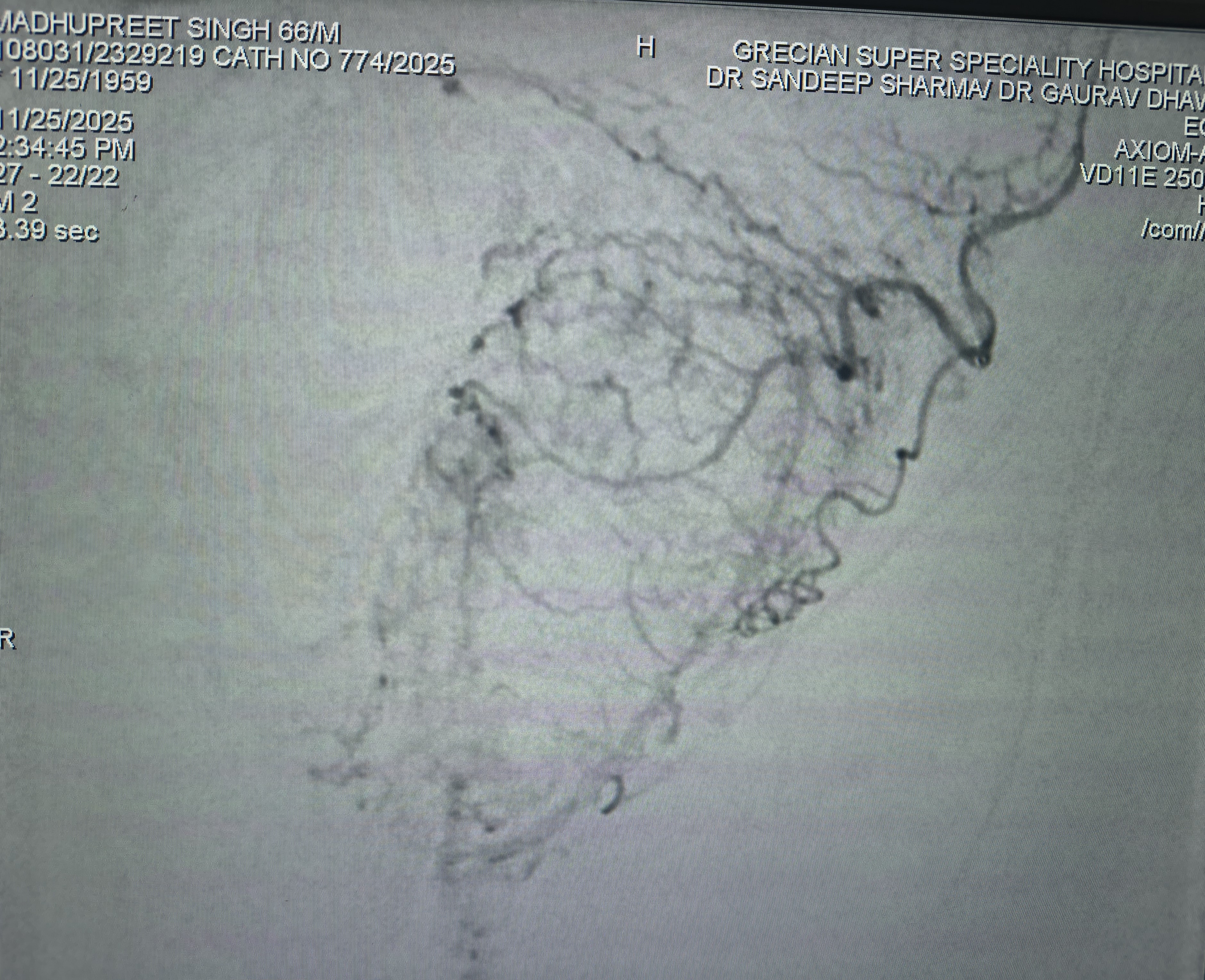 Left Prostatic Artery